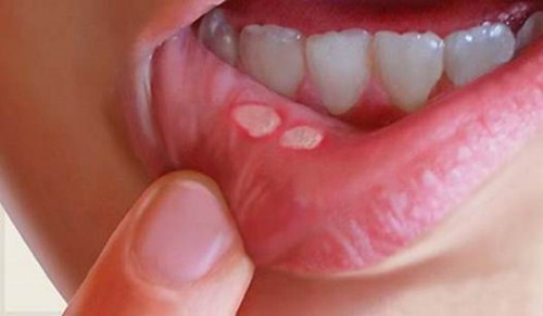 8. Điều trị tình trạng viêm loét khoang miệng cấp tính của trẻ em do nhiễm nấm hoặc kí sinh trùng: Dùng nước tiểu sắc uống cùng cam thảo. Ảnh: suckhoedoisong.vn.