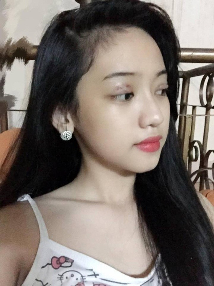 Sau khi chiếc mũi đã tạm ổn, tình tin đồn của Phan Thành lại khoe ảnh cắt mí. Khi nhiều người chê ảnh cắt mí của cô không được đẹp thì cô nàng chữa cháy rằng, mới làm chưa hoàn thiện. Ảnh: FBNV.