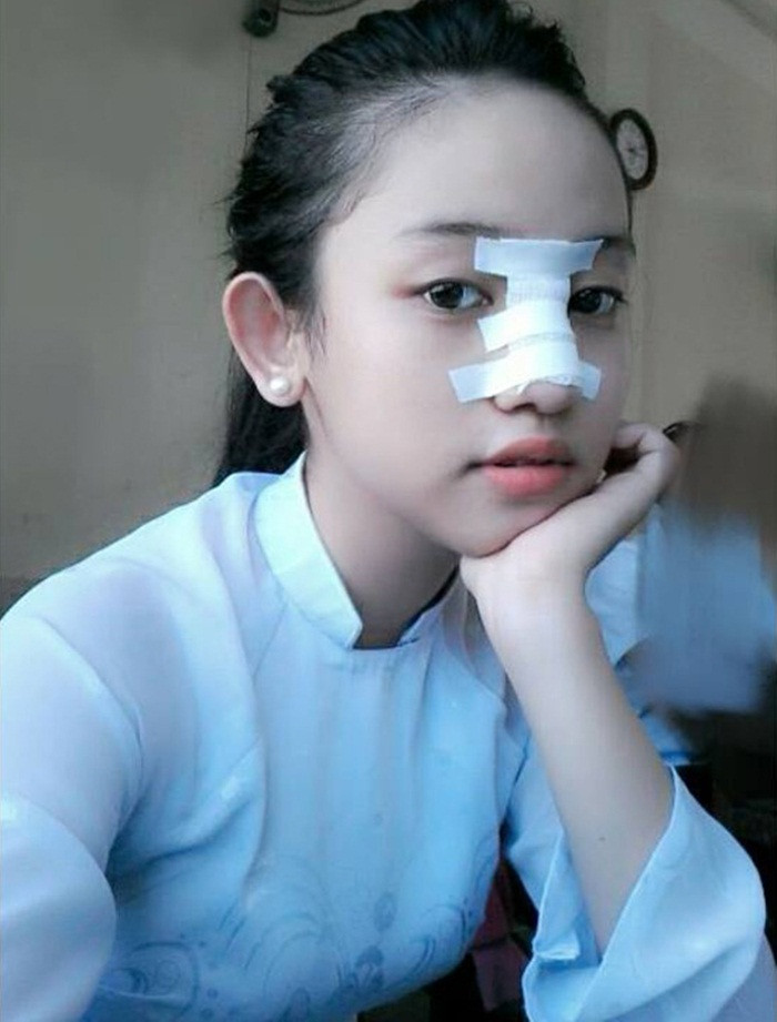 Sau đó, cô nữ sinh công khai hình ảnh nâng mũi trên trang cá nhân. Ảnh: Moththegioi.