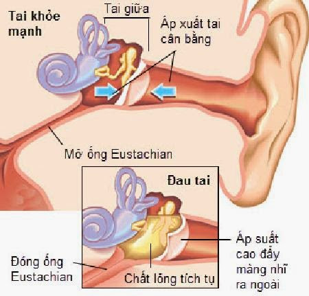 Nhiều trường hợp bệnh nhân bị viêm tai giữa nhẹ nhưng do ngoáy tai nhiều và quá sâu gây tổn thương, làm nhiễm khuẩn ống tai ngoài, tai đau nhức, chảy mủ, ù tai, nghe kém thậm chí một số bệnh nhân đến khám khi ống tai ngoài bị viêm tấy lan tỏa ra nửa mặt, chảy máu lẫn nước mủ ra cửa tai. Ảnh: chuaviemtaigiua.com.