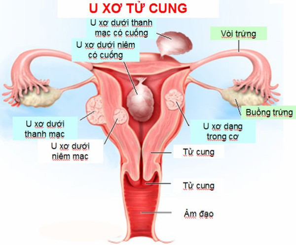 Hoặc cũng có thể do viêm nhiễm nấm hoặc các bệnh như: U xơ tử cung: u xơ dưới niêm mạc, dị dạng tử cung, lao sinh dục, có các khối u nội tiết của buồng trứng. Ảnh: chuauxotucung.net.