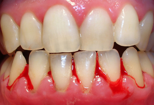 3. Chảy máu chân răng. Do bệnh tiểu đường: Căn bệnh về chuyển hóa liên quan đến mức độ sản xuất, hấp thụ đường và insulin trong máu. Nếu không chữa trị, bệnh tiểu đường có thể dẫn đến các vấn đề sức khỏe nghiêm trọng.