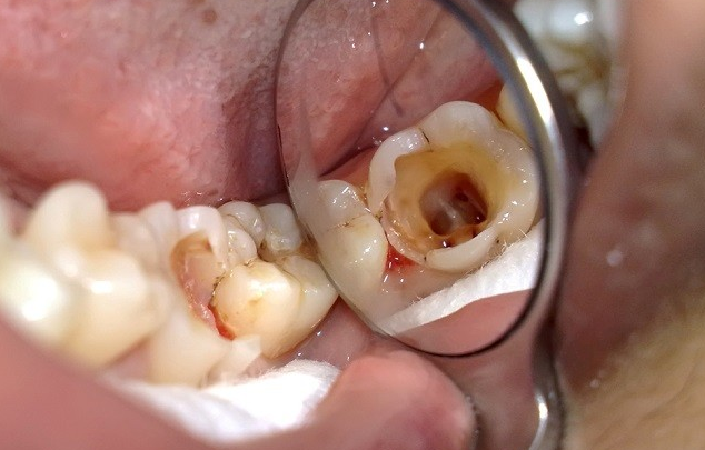 Đau răng, sâu răng: Đơn kim thảo cả hoa và lá, giã nát với một ít muối trắng. Viên thành viên nhỏ, nhét vào chỗ đau răng hoặc sâu răng. Ảnh: kienthucnhakhoa.edu.vn.