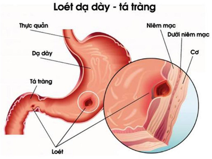 Viêm loét dạ dày, tá tràng: Bồ công anh 40g, lá Khôi, Nghệ vàng 20g, Mai mực 10g, Cam thảo 5g. Sắc uống ngày một thang. Ảnh: bacsydaday.com.