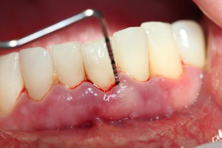 Trị nướu răng, viêm miệng, viêm họng: Lấy một chén lá vú sữa tươi đã cắt nhuyễn đun với 2 cốc nước trong vòng 10 phút để súc miệng mỗi ngày. Ảnh: chuadaurang.vn.