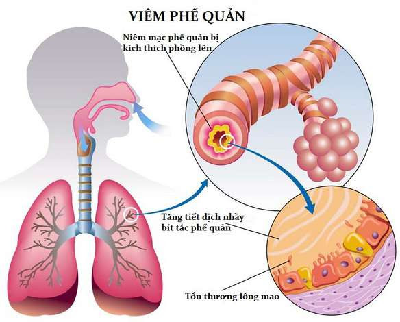 5. Điều trị viêm phế quản mãn tính: Củ cải đỏ rửa sạch, không gọt vỏ, cắt thành những lát mỏng, cho vào trong chén. Thêm 2 - 3 thìa đường vào chén củ cải đã cắt lát, trộn đều, ủ trong vòng 12 tiếng đồng hồ. Khi đường tan thì lấy nước siro đó uống. Ảnh: pqa.com.vn. (Thông tin trong bài chỉ mang tính chất tham khảo, trước khi sử dụng bài thuốc, vui lòng hỏi ý kiến bác sĩ).