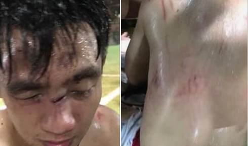 Đánh nhau nhập viện vì mâu thuẫn khi đá bóng: Ngày 16/7/2019, 2 đội bóng tự do hẹn nhau giao lưu bóng đá tại sân bóng ở số 104 Nguyễn An Ninh, Hà Nội. Một đội bóng tự do có khoảng 15 người, trong đó có một số người xăm trổ; đội còn lại có khoảng 10 người là sinh viên cùng một số người đang làm việc tại Hà Nội. Khi tranh chấp bóng, giữa 2 thành viên của 2 đội đã xảy ra va chạm. Lúc này, đội bóng có một số nam thanh niên xăm trổ đã lao vào đánh hội đồng đối thủ đội bạn. Các thành viên trong nhóm bị hại đã lao vào can ngăn nhưng cũng bị đội bóng “xăm trổ” hành hung. Đội bị hại có 1 thành viên bị thương nặng được đưa đi cấp cứu, các thành viên còn lại bị thương nhẹ. (Ảnh: Infonet)