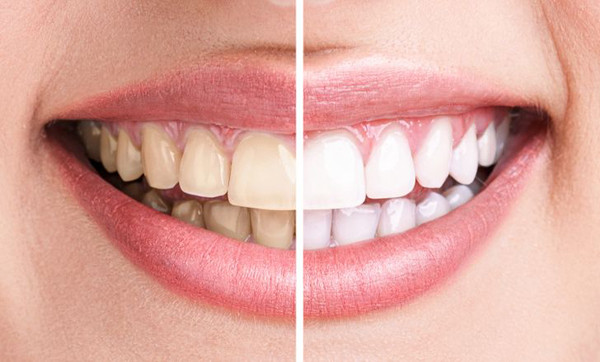 Răng trắng chứng tỏ răng khỏe mạnh. Hàm răng mỗi người sẽ có độ trắng khác nhau và không phải tất cả những người có hàm răng trắng đều khỏe mạnh. Màu sắc này có thể bắt nguồn từ men răng. Ngoài ra, các yếu tố khác như di truyền, lão hóa, hút thuốc cũng có thể làm xỉn màu men răng.