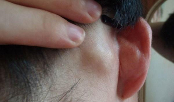 Vị trí không nên hôn thứ hai – Tai. Tai là bộ phận nhạy cảm, khi bị tổn thương dễ gây hậu quả nghiêm trọng. Khi dùng lực cắn hoặc mút, nó sẽ uy hiếp đến chức năng hoạt động của màng nhĩ. Không ít trường hợp ù tai từng được ghi nhận bởi những nụ hôn.
