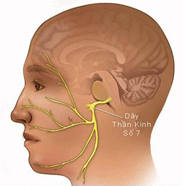 Nguyên nhân thứ phát thường diễn ra sau nhiễm siêu vi như Zona vùng hạch gối, chấn thương vỡ xương đá, u chèn ép, biến chứng của đái tháo đường hoặc các bệnh lý tự miễn.