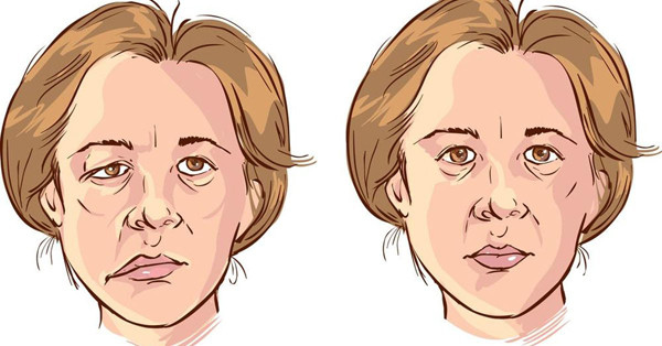 Dây thần kinh số VII còn có vai trò chi phối cơ vùng tai giữa liên quan đến chức năng tiếp nhận âm thanh và đảm nhiệm cảm nhận vị giác 2/3 trước lưỡi. Vì vậy, liệt dây thần kinh mặt sẽ gây ra các biểu hiệu mất cân bằng về chức năng cũng như thẩm mỹ của một nửa mặt.