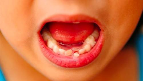Ngay sau đó, Kỳ Kỳ được đưa vào phòng cấp cứu. Thậm chí được chuyển tuyến lên Bệnh viện trực thuộc Đại học Y Quảng Tây song cô bé không qua khỏi. Nhìn con gái đang khỏe mạnh bỗng chết não vì nhổ răng khiến bố mẹ vô cùng đau lòng.