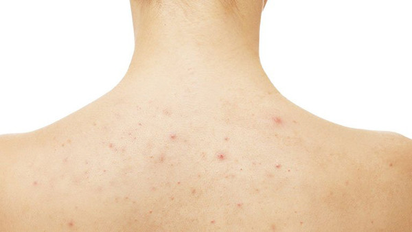 Một nguyên nhân khác dẫn tới mụn tập trung nhiều ở mặt và lưng là do tình trạng viêm nang lông. Viêm nang lông có thể do tóc bị kéo, cọ xát, gãi nhiều gây tổn thương. Vi khuẩn và nấm có thể dễ dàng thâm nhập vào nang lông để sinh sôi. Được biết, viêm nang lông do nấm Malassezia furfur là chủ yếu, gây mụn mủ.