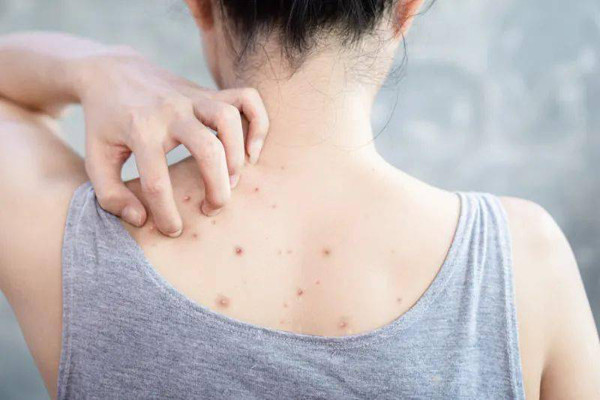 Mụn thường mọc ở lưng và mặt – vị trí rất dễ quan sát, khiến bạn e ngại về vẻ bề ngoài hoặc có ý định mặc áo hở lưng. Lý giải về điều này, chuyên gia sức khỏe cho biết mụn ở mặt và lưng bắt nguồn từ việc bố trí tuyến bã nhờn trên cơ thể.