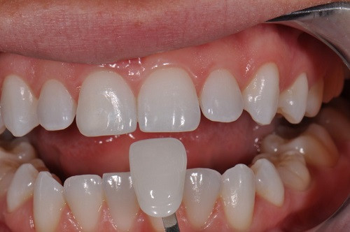 Việc dán răng sứ dễ thực hiện và đơn giản hơn nhiều các phương pháp khác. Ảnh: niengrangkhongmaccai.