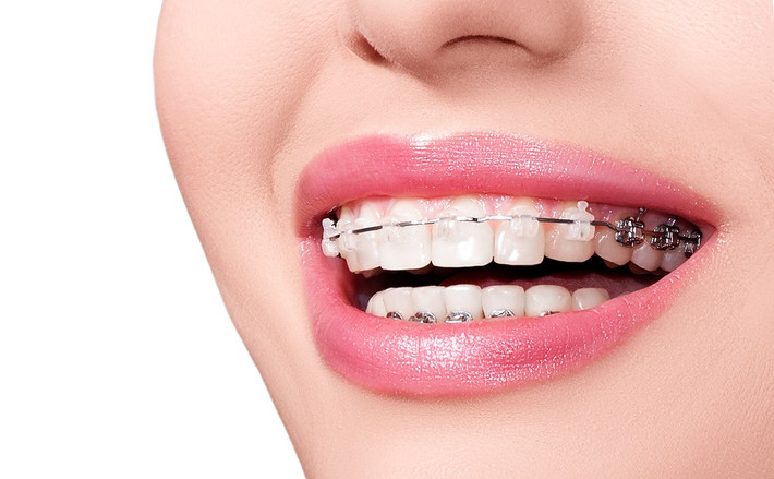 Niềng răng cũng là phương pháp thẩm mỹ răng phổ biến có tác dụng sắp xếp lại vị trí các răng cũng như thay đổi hình dáng cung hàm. Ảnh: dep.