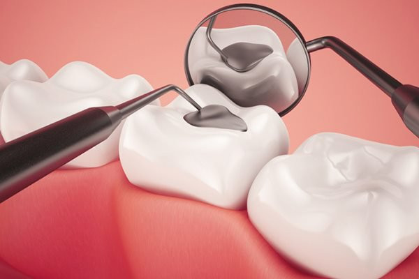 Các vết trám tồn tại được vài năm nhưng nó vẫn có thể bị mài mòn, mẻ hoặc ố màu. Ảnh: cloudfront.