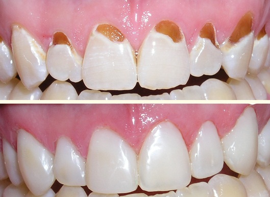 Trong khi đó, phương pháp trám răng có thể cải thiện hình dáng răng nếu chúng bị sứt mẻ, vỡ, ố hoặc nứt thành khe lớn. Ảnh: imgur.