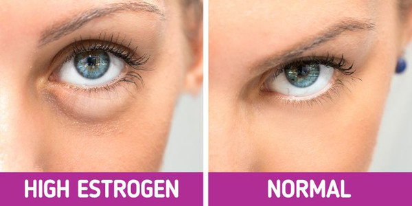 Điều hòa estrogen: Mất cân bằng estrogen có thể gây nên các triệu chứng như tăng sắc tố da, gương mặt phù nề, rạn da... Do vậy, điều hòa estrogen trong cơ thể cũng là cách trị tận gốc tình trạng phù nề ở mặt.