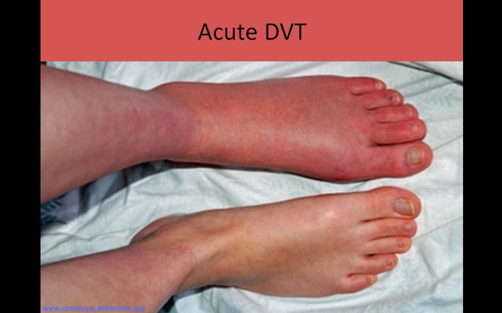 Da xuất hiện màu bất thường. Các cục máu đông sẻ cản trở việc lưu thông máu khiến da nhợt nhạt hoặc mất màu một cách bất thường. Hoặc nếu như da chuyển thành màu đỏ hoặc màu tím là dấu hiệu của bệnh này. Ảnh: Ultrasound Registry Review.