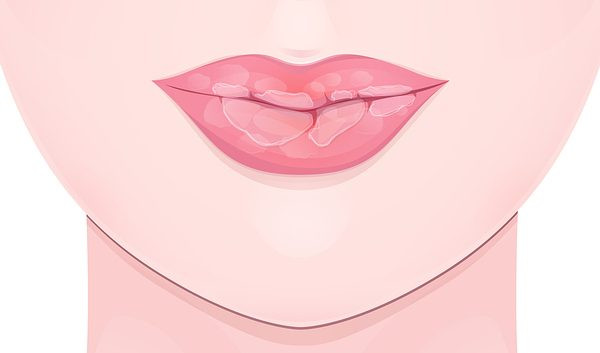 Da khô nứt nẻ. Không phải mất nước mà da nứt nẻ thì do cơ thể thiếu nước trầm trọng, hoặc đó là dấu hiệu của bệnh tiểu đường, suy giáp, thiếu vitamin B.... Bệnh này có thể đơn giản chữa bằng cách bù nước hàng ngày.