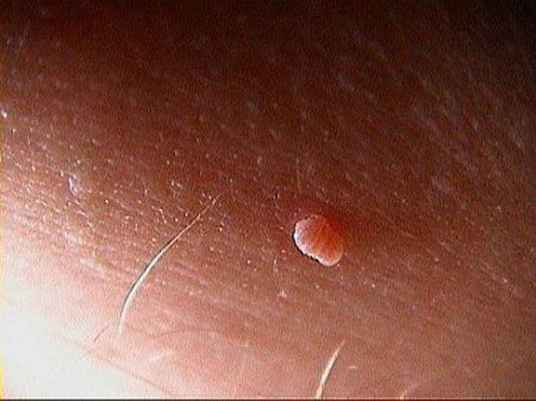 Nguyên nhân gián tiếp đến từ chế độ sinh hoạt và thói quen sống như ăn uống thiếu chất, sử dụng nhiều chất kích thích, mỹ phẩm có các thành phần gây tổn thương làn da, dùng các loại thuốc ảnh hưởng nội tiết...