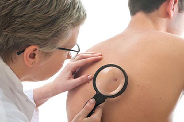 Virus polyma tế bào Merkel (MCV). MCV được phát hiện năm 2008 trong mẫu xét nghiệm từ một loại ung thư da hiếm gặp. Đây được gọi là ung thư biểu mô tế bào Merkel. Hầu hết mọi người nhiễm MCV vào một thời điểm nào đó (thường là thời thơ ấu), và phần lớn không có triệu chứng. Nhưng ở một vài người có nhiễm virus này sẽ ảnh hưởng đến ADN trong tế bào, có thể dẫn đến ung thư tế bào Merkel.