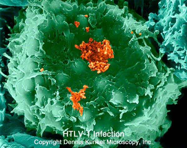 Virus dưỡng Lympo HTLV-1. Virus này có liên quan đến một loại bệnh bạch cầu dòng lympho và u lympho không Hodgkin được gọi là bệnh bạch cầu hay u lympho tế bào T trưởng thành(ATL). Loại ung thư này được tìm thấy chủ yếu ở miền Nam Nhật Bản, Caribbe, Trung Phi, một phần Nam Mỹ, trong một số nhóm người nhập cư ở miền Đông Nam nước Mỹ.
