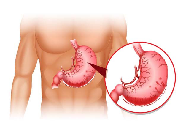 Lúc đó, dịch dạ dày sẽ đi qua ruột non, ruột già rồi đào thải ra ngoài theo phân. So với các bệnh trên, người bị chảy máu dạ dày phân có dính máu màu đỏ sẫm. Chính quá trình máu chuyển từ ruột già khiến các ion sắt trong máu bị oxy hóa, làm chúng bị thay đổi màu sắc.