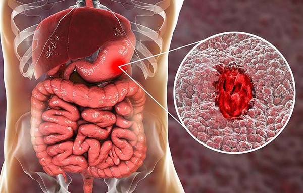Chảy máu dạ dày. Một số trường hợp viêm dạ dày mãn tính hoặc viêm loét dạ dày cấp tính cũng có khả năng đại tiện phân dính máu. Tình trạng này bắt nguồn từ việc niêm mạc dạ dày hoạt động bất thường gây chảy máu.