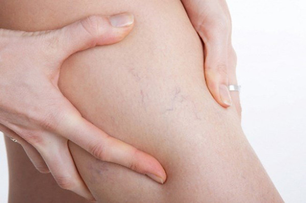Sưng phù chi dưới. Đứng hoặc uống nước nhiều có thể gây tình trạng phù nề sinh lý. Tuy nhiên, hiện tượng này sẽ nhanh chóng được cải thiện khi bạn áp dụng chế độ sinh hoạt khoa học.