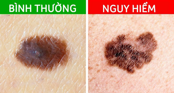 Khi mắc bệnh, các nốt ruồi ở chân có xu hướng gia tăng về kích thước, các cạnh giới thay đổi, bề mặt trở nên lở loét. Đáng nói, mắc ung thư da thì tình trạng này diễn ra rõ rệt nhất.
