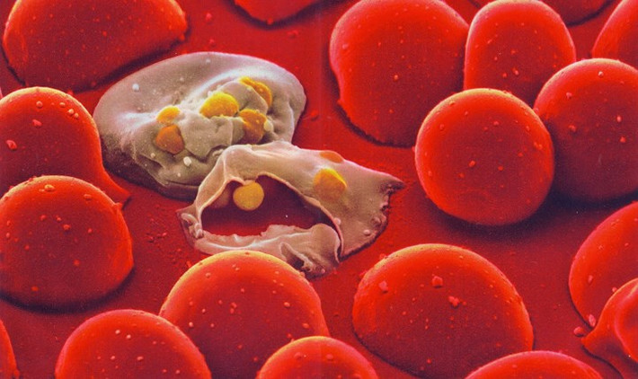 2. Bệnh tan máu huyết tán Thalassemia: Là một trong những căn bệnh di truyền ở người, liên quan đến máu và có thể gây ra các biến chứng nguy hiểm cho người bệnh. Nguyên nhân gây ra căn bệnh này là do các gen lặn ở bố và mẹ, nếu cả bố mẹ đều mang gen bệnh thì 75% trẻ sinh ra bị mắc bệnh này. Bệnh kéo dài đến suốt cuộc đời bệnh nhân và họ sẽ phải truyền máu cả đời. Một số triệu chứng của bệnh như là thiếu máu thường xuyên và thừa sắt. Nếu ở thể bệnh nặng, trẻ thường tử vong sau khi sinh khoảng 4 tháng.