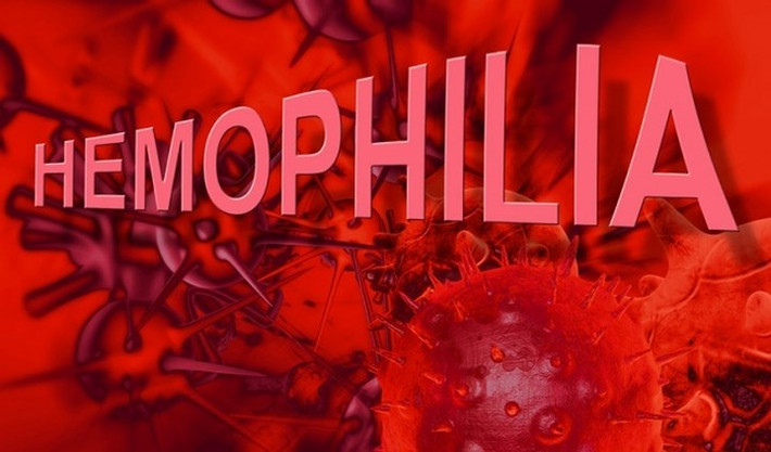 4. Bệnh máu khó đông di truyền (Hemophilie A): Đây là một trong những bệnh có tính di truyền liên quan đến nhiễm sắc thể giới tính X do gen sản xuất ra yếu tố đông máu chỉ nằm trên nhiễm sắc thể này. Vì thế, bé trai (bộ sắc thể XY) khi nhận sắc thể X bị bệnh từ mẹ thì chắc chắn sẽ có biểu hiện bệnh. Còn đối với bé gái (bộ nhiễm sắc thể XX) chỉ biểu hiện thành bệnh khi cả hai bố mẹ đều có nhiễm sắc thể mang gen bệnh.