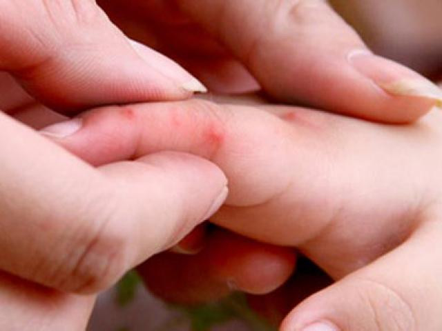 Tiếc là, đến nay vẫn chưa có vắc xin phòng bệnh tay chân miệng. Nguy cơ lây nhiễm bệnh có thể được giảm thiểu bằng việc thực hiện tốt vệ sinh cá nhân và chăm sóc y tế kịp thời những trẻ em bị bệnh.