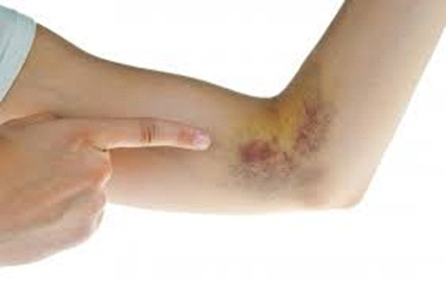 Vết thâm dưới cánh tay hoặc sau cổ. Đây có thể là dấu hiệu của kháng insulin và đây là tiền triệu hay gặp của bệnh tiểu đường, thường là do béo phì hoặc chế độ ăn nhiều đường và carbohydrate tinh chế. Cũng có thể đó là dấu hiệu của bệnh buồng trứng đa nang.