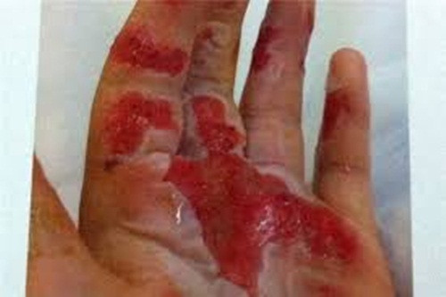 Bỏng lạnh. Nếu lạnh quá thì cơ thể sẽ gây ra bệnh mất cảm giác và màu sắc ở những vùng da như tai, mũi, cằm, má sẽ thay đổi. Thương tổn này có thể phá hủy các mô và nặng sẽ phải cắt bỏ vùng thương tổn. Những người bị giảm tuần hoàn máu hay mặc không đủ ấm thường hay bị bệnh này.