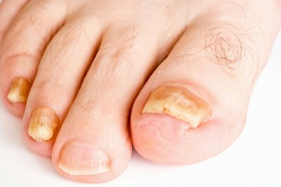 Ngón chân không có lông. Không ai thực sự muốn có một bàn chân lông lá, nhưng nếu không có cọng nào ở đầu ngón chân thì cũng đáng lo. Chứng tỏ việc tuần hoàn máu kém. Không đủ máu khiến cơ thể ưu tiên các phần khác chứ không đến phần chân.