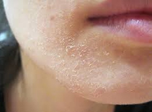 Đỏ và dễ bong tróc. Đây là dấu hiệu của việc thiếu hụt vitamin B và axit béo thiết yếu. Nhiều người lầm tưởng đây là bệnh viêm da nhưng thực chất bạn cần tăng dinh dưỡng trong chế độ ăn uống. Cũng có thể bạn đang gặp vấn đề về đường ruột, thiếu hormone, đang uống thuốc ngừa thai, uống nhiều rượu hay ăn nhiều thực phẩm chế biến.