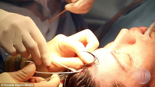 Các bác sĩ đang thực hiện thủ thuật loại bỏ tĩnh mạch trên trán của búp bê sống.
