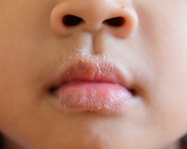 Khô miệng và sâu răng. Khi thở bằng miệng, luồng không khí sẽ làm khô môi và khoang miệng, trong đó bao gồm cả nướu. Điều này làm thay đổi môi trường vi khuẩn sống trong miệng, gây các vấn đề về nướu, sâu răng.