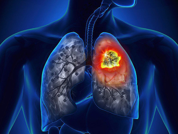 Ung thư phổi. Theo trang 39Health, tỷ lệ nam giới mắc ung thư phổi cao hơn phụ nữ. Tình trạng này bắt nguồn từ thói quen hút thuốc lá. Được biết, khói thuốc lá chứa hơn 7.000 hóa chất, trong đó có 69 chất gây ung thư. Khi đi vào cơ thể, những chất độc hại sẽ tác động, làm tăng nguy cơ ung thư phổi.