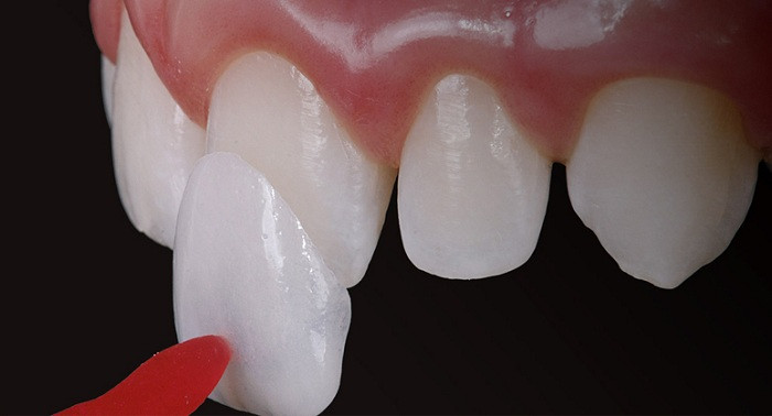 So với những phương pháp thẩm mỹ nha khoa khác, dán răng sứ Veneer có nhiều ưu điểm như không gây ê buốt khi ăn nhai, không tác động đến mô răng thật và giữ được màu răng trắng sáng trong thời gian dài. Ảnh: nhakhoakim.