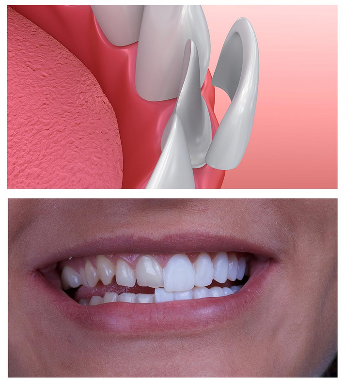 Bạn cũng nên khám răng 6 tháng/ lần để nha sĩ kiểm tra mặt dán Veneer và xử lý kịp thời những sai lệch khi dán miếng Veneer. Ảnh: kimiafamilydentistry.