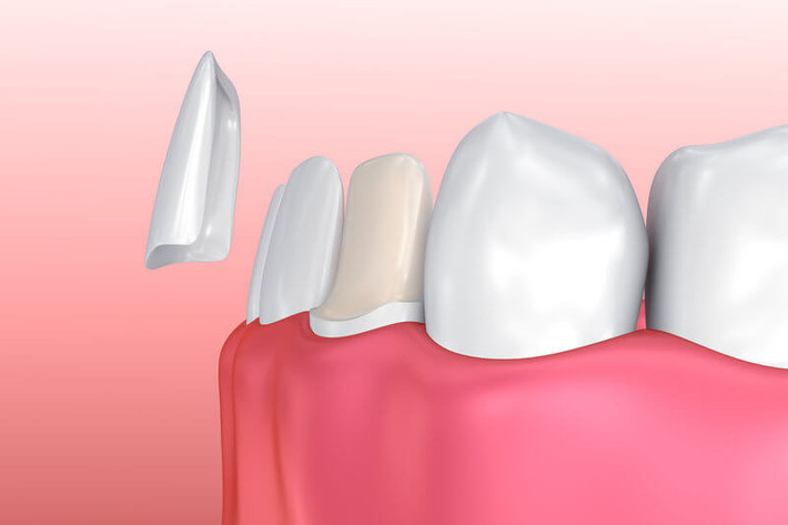 Ngoài ra, bạn cũng không nên hút thuốc lá sau khi thực hiện dán răng sứ Veneer để đảm bảo độ bền và đẹp của răng. Ảnh: nhakhoasaomy.