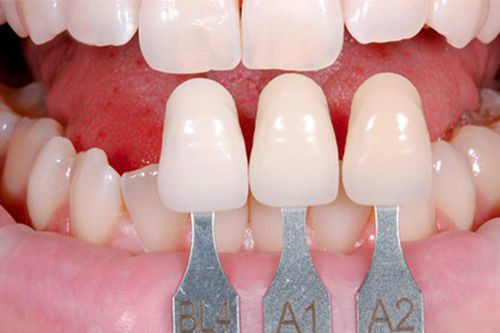 Sau khi thực hiện dán răng sứ Veneer, bạn nên kiêng ăn uống một vài loại thực phẩm, trong đó có những thực phẩm quá nóng, quá lạnh, đồ ăn cứng, dai. Ảnh: nhakhoaquoctevietduc.