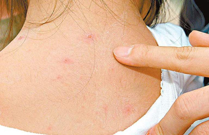 Đặc biệt, trẻ thường hay mắc các bệnh như sởi, thủy đậu, tay chân miệng trong mùa nắng nóng. Ảnh: thuocdantoc.
