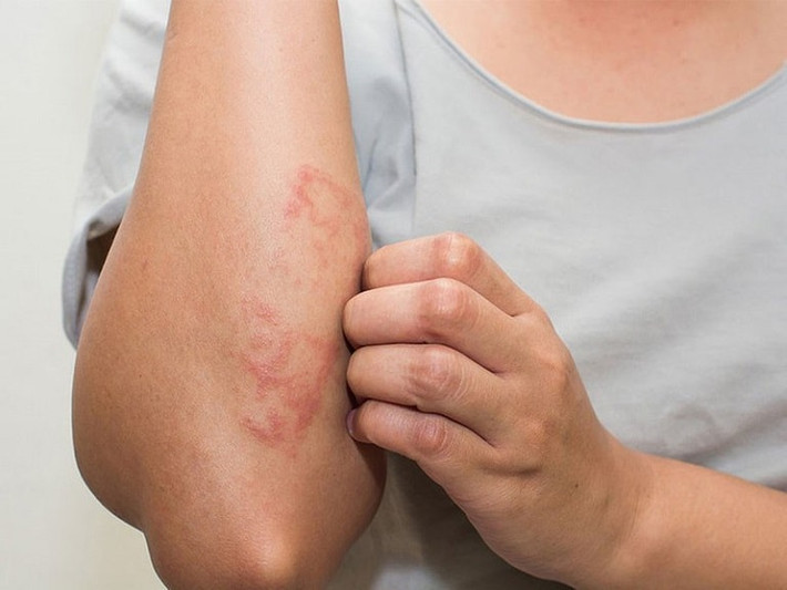 Ngoài ra, vào mùa nắng nóng, một số bệnh về da cũng thường gặp ở người cao tuổi như viêm da dị ứng gây ngứa, bệnh Zona.... Ảnh: thuocdantoc.