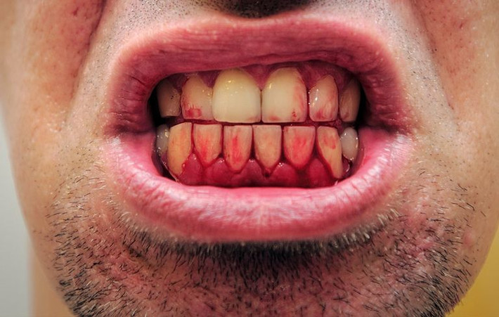 Nếu bạn bị chảy máu chân răng thì đây cũng có thể là dấu hiệu cho thấy lượng đường trong máu quá cao. Ảnh: menshealth.