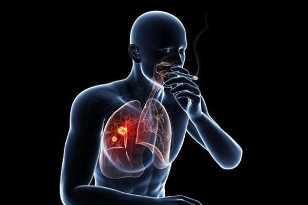 Lý giải điều này, các nhà khoa học cho rằng những yếu tố bên ngoài như hút thuốc lá, sống trong môi trường chứa chất độc hại ảnh hưởng tiêu cực đến chức năng phổi, làm tăng nguy cơ mắc ung thư. (Ảnh minh họa)